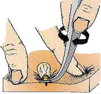 Zecken entfernen mit einer Pinzette